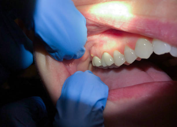 Best Emergency Treatment for Toothache in Locust Grove, OK